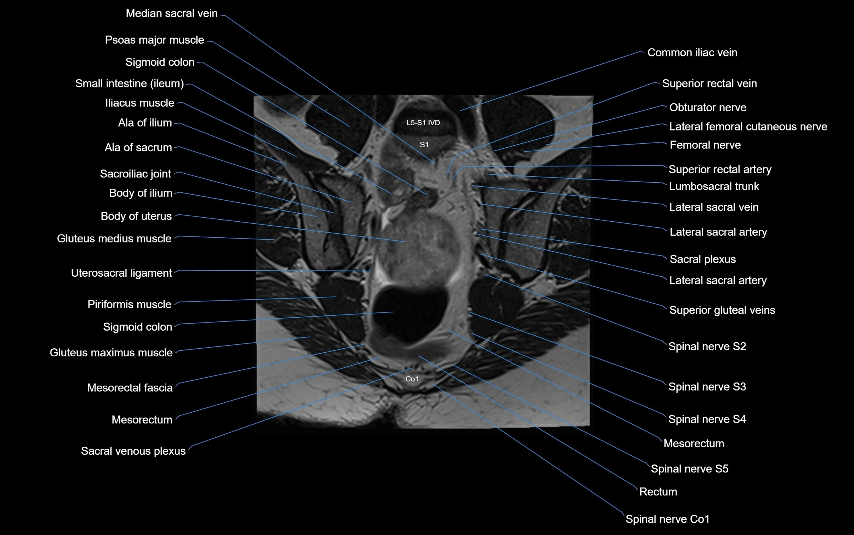 MRI sacroiliac joint coronal cross sectional anatomy  radiology  image-img-00001-00012.webp